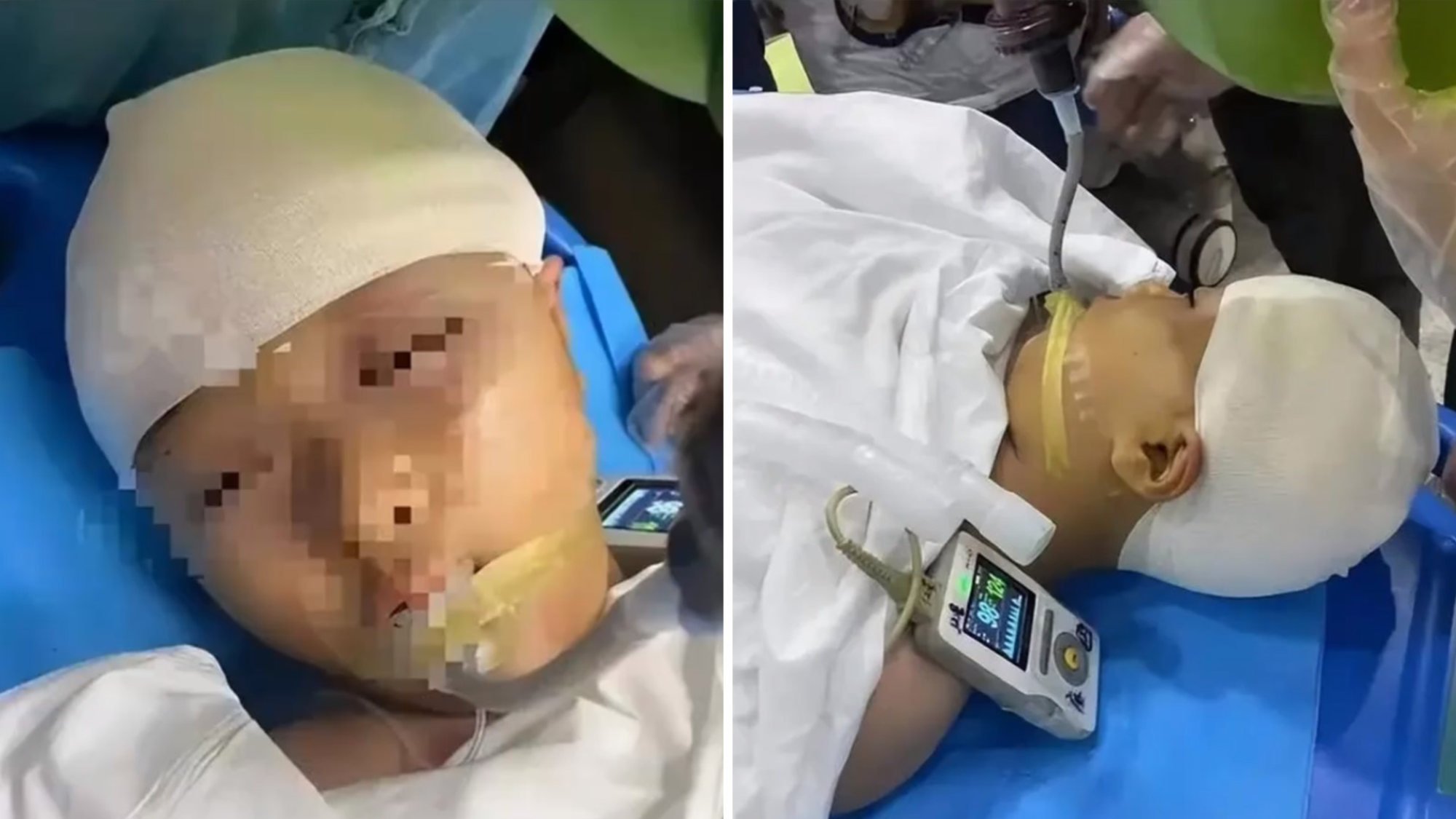 Tests revealed the girl’s skull was fractured and bone fragments were lodged in her head, requiring almost five hours of emergency surgery. Photo: SCMP composite/Baidu death and debt in china taiwan reacts to plas new carrier korean visitor in hong kong molested scmps 7 highlights 4