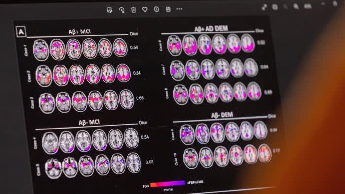 New studies find benefits in very early drug treatment of Alzheimer’s 1 new studies find benefits in very early drug treatment of alzheimers